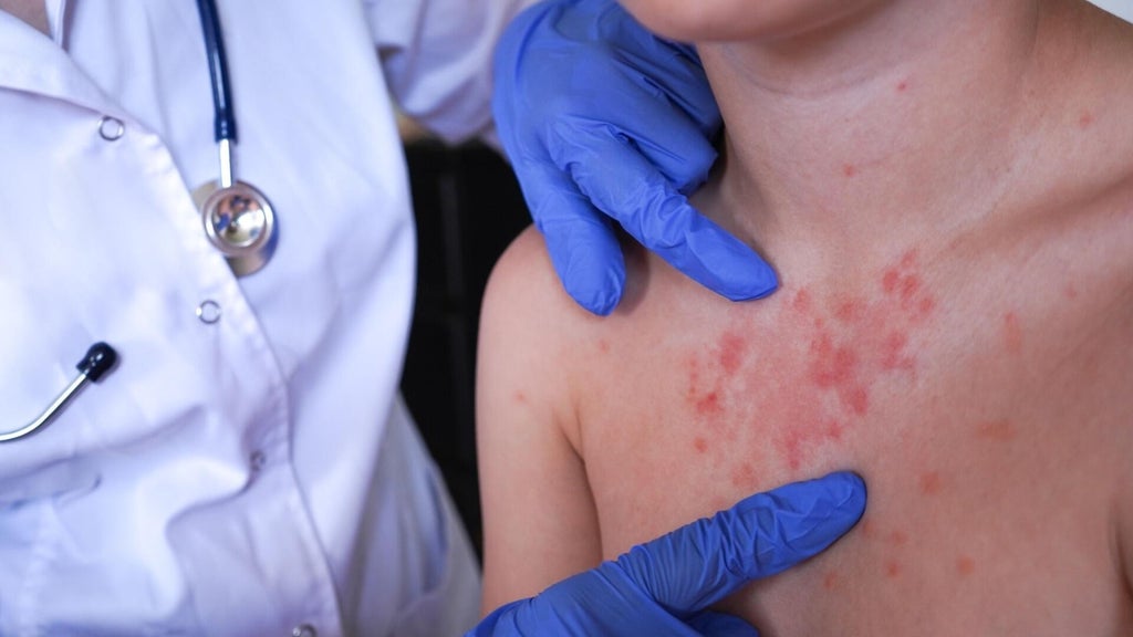 Minnesota's 80 measles cases this year are the most since 1990, health officials say — Eden Prairie Health news